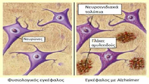 kainotoma-aimatologiki-exetasi-gia-tin-egkairi-diagnosi-tis-nosou-Alzheimer